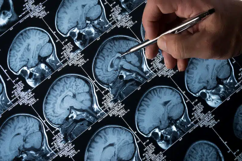 Brain MRI imaging review for a neuromodulation programme under EU MDR